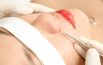 Bộ 3 Hoàn Hảo : Lấy Nhân Mụn + Peel + Ultrayoung Yag