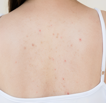 Điều Trị Mụn Body