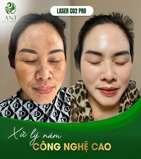 Khoá Học Chuyên Sâu Điều Trị Nám – Xoá Mờ Thâm Sạm, Lấy Lại Làn Da Trắng Sáng!