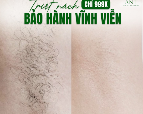TRIỆT NÁCH CHỈ 999K BẢO HÀNH VĨNH VIỄN